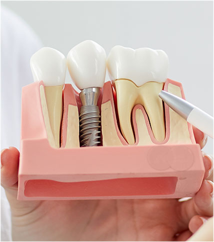 Model of a dental implant.