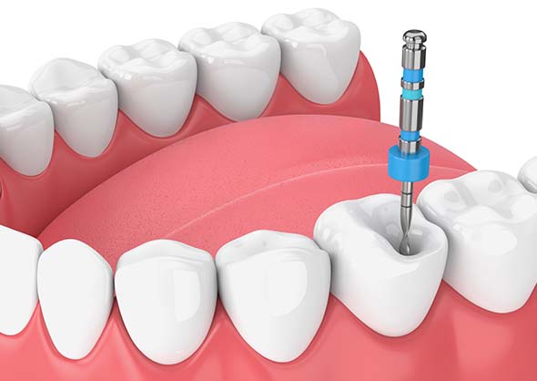 Diagram of tooth being prepped for root canal.